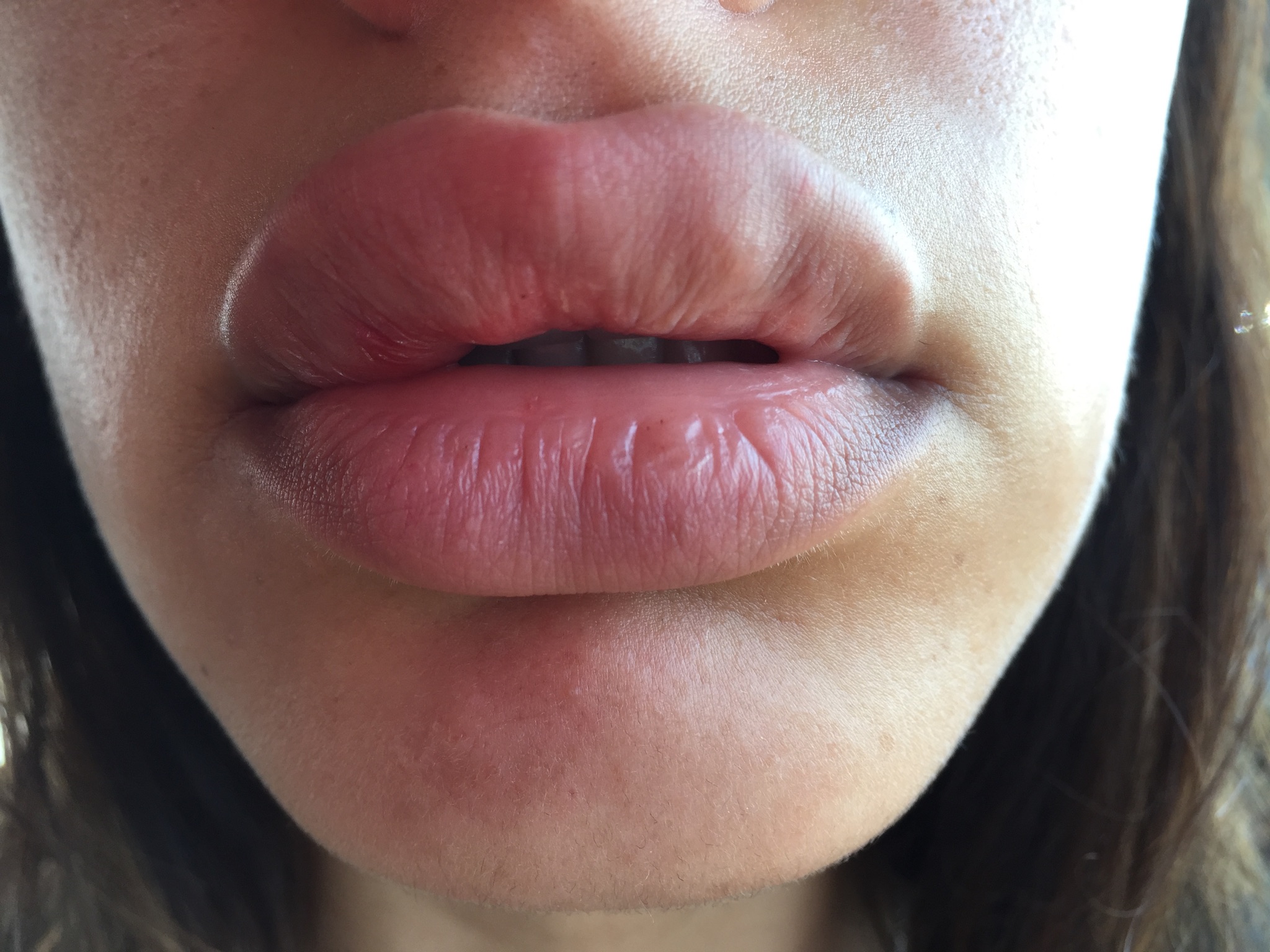 Big Lips With Juvederm Are Not Always Better Lips Orange County Ca