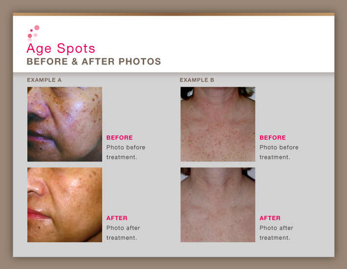 Orange County Age Spot Treatment & Removal